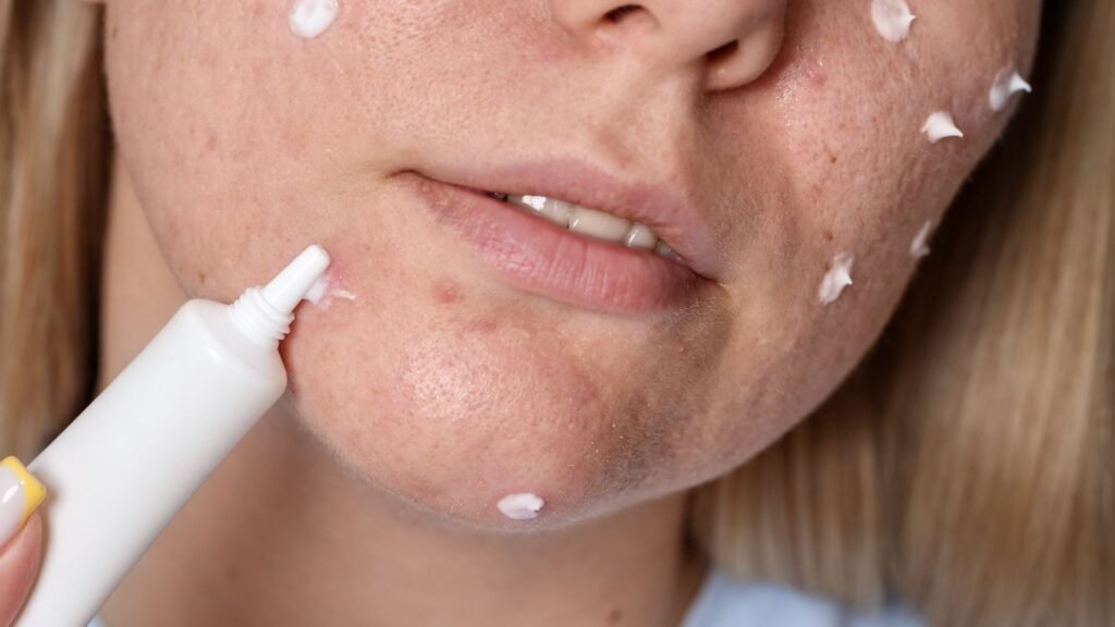 ใช้ครีม รักษาหลุมสิว ให้ได้ผลตามหลักการแพทย์