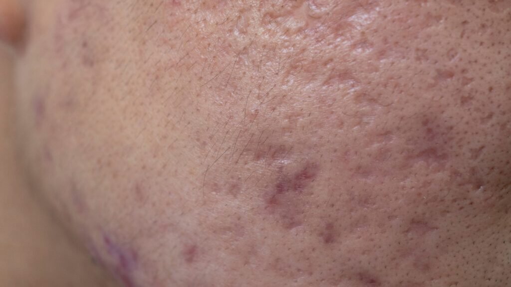 รักษาหลุมสิวยังไง