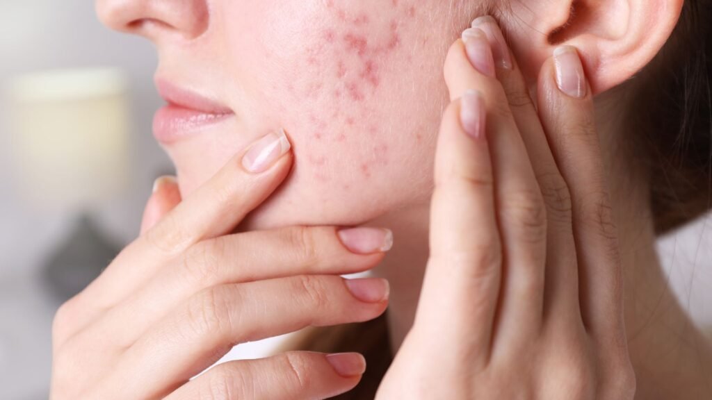 รักษารอยสิว