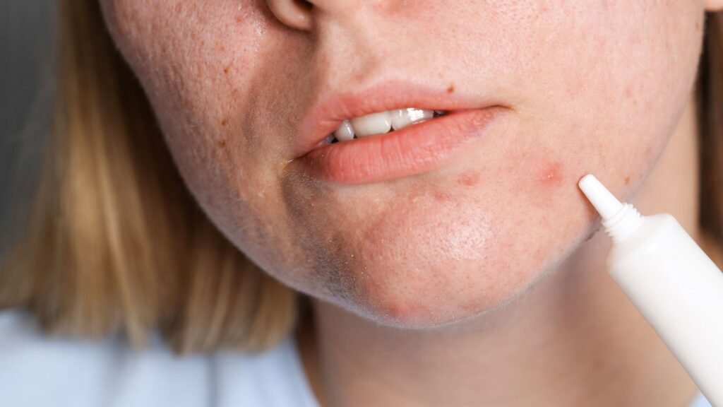 การใช้ครีมหรือเซรั่มลดหลุมสิวได้ผลแค่ไหน