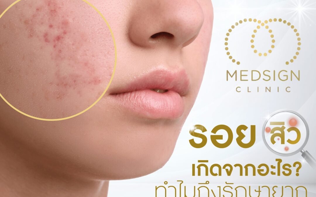 รอยสิวเกิดจากอะไร ทำไมถึงรักษายาก รวมวิธีรักษารอยสิวและเลเซอร์รักษารอยสิว โดยแพทย์ผู้เชี่ยวชาญจากเม็ดทรายคลินิก