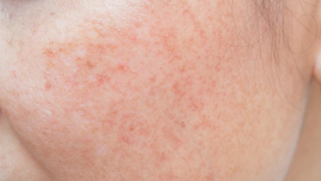 ข้อควรระวังในการ รักษาฝ้ากระด้วยตัวเอง