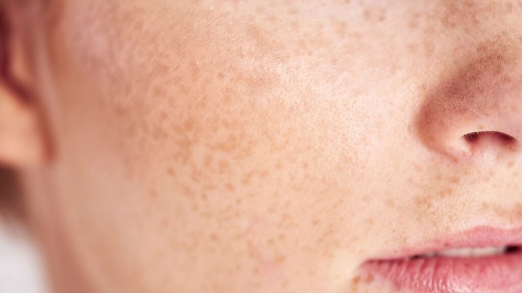 รักษาฝ้ากระด้วยตัวเอง ได้ไหม?