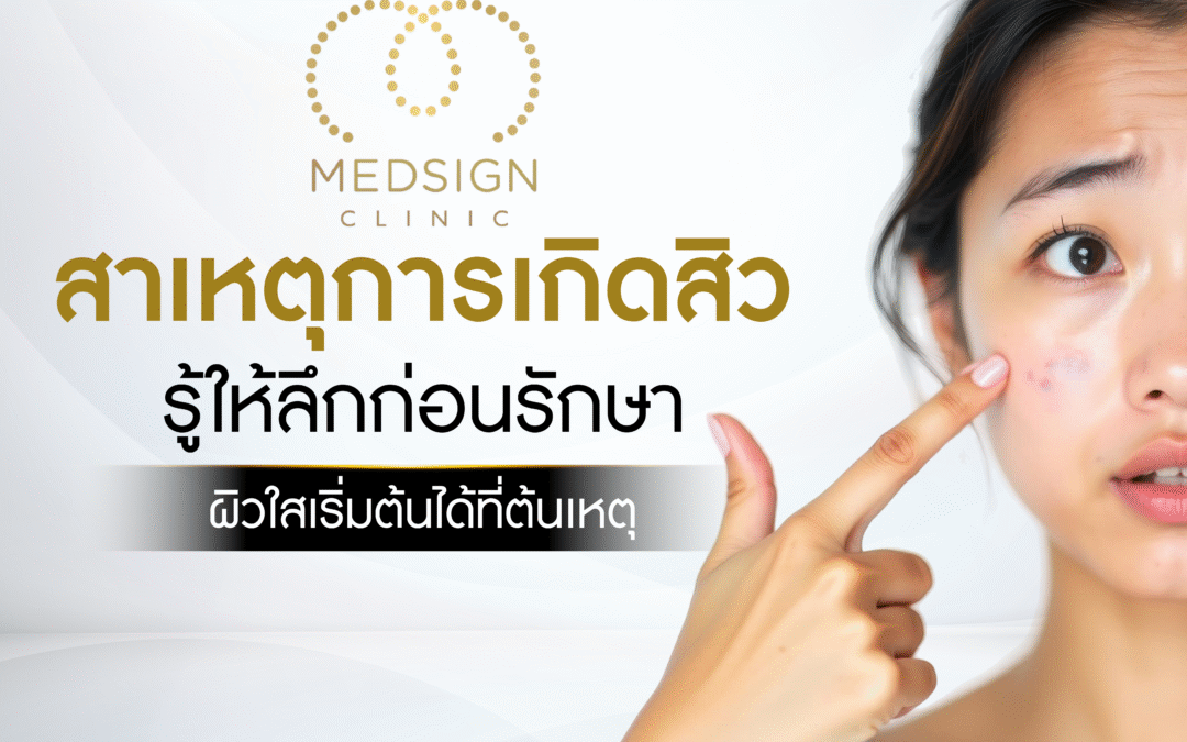 สาเหตุการเกิดสิว รู้ให้ลึกก่อนรักษา ผิวใสเริ่มต้นได้ที่ต้นเหตุ