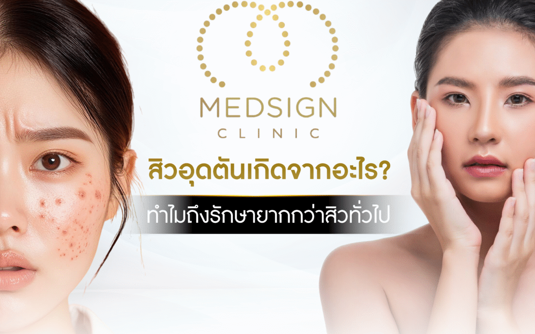 สิวอุดตันเกิดจากอะไร? ทำไมถึงรักษายากกว่าสิวทั่วไป