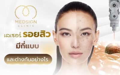 เลเซอร์รอยสิวเชียงใหม่ หรือ รักษารอยสิวเชียงใหม่ มีกี่แบบ และต่างกันอย่างไร เปรียบเทียบเทคโนโลยีรักษารอยสิวเชียงใหม่จากแพทย์ผู้เชี่ยวชาญ