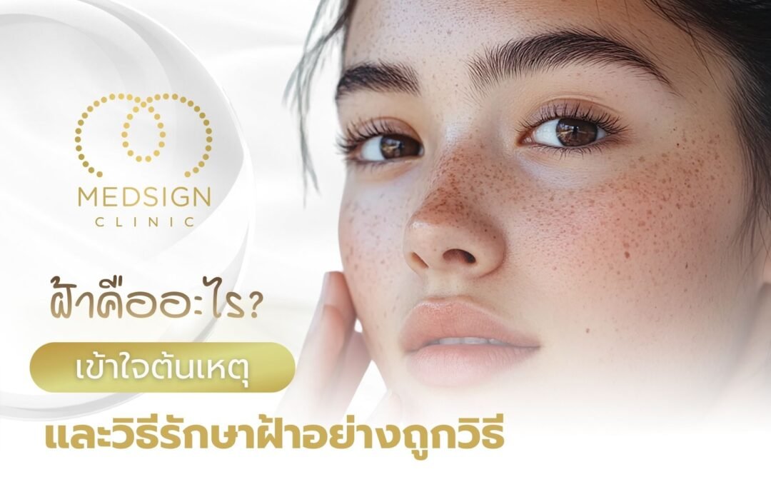 ฝ้าคืออะไร สาเหตุและวิธีรักษาฝ้าอย่างถูกวิธี