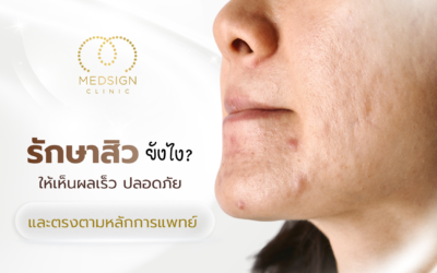 รักษาหลุมสิวยังไง ให้เห็นผลเร็ว ปลอดภัย และตรงตามหลักการแพทย์