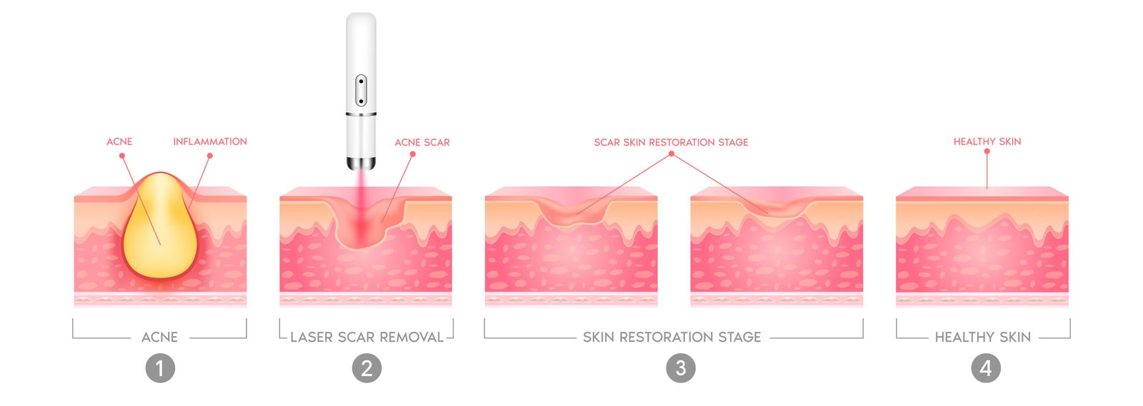 ขั้นตอนการเลเซอร์รักษาหลุมสิวที่ Medsign Clinic