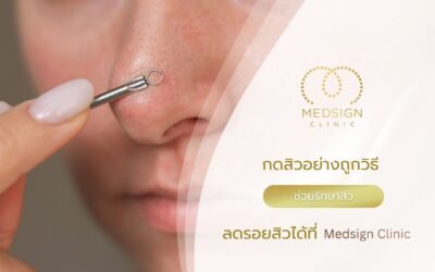 กดสิวอย่างถูกวิธี ช่วยรักษาสิว ลดรอยสิวได้ที่ Medsign Clinic