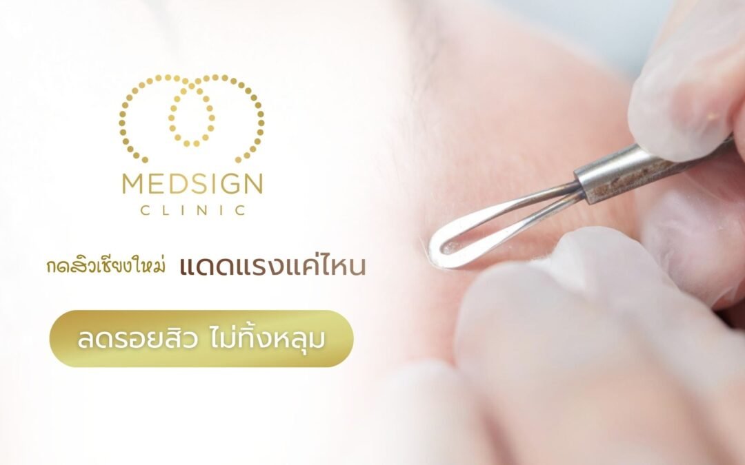 กดสิวเชียงใหม่ แดดแรงแค่ไหนก็ปลอดภัย ลดรอยสิว ไม่ทิ้งหลุม