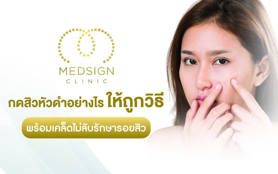 กดสิวหัวดำอย่างไรให้ถูกวิธี พร้อมเคล็ดไม่ลับรักษารอยสิวให้จางลง