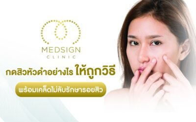 กดสิวหัวดำอย่างไรให้ถูกวิธี พร้อมเคล็ดไม่ลับรักษารอยสิวให้จางลง