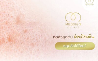 กดสิวอุดตัน ช่วยป้องกันหลุมสิวได้ไหม?