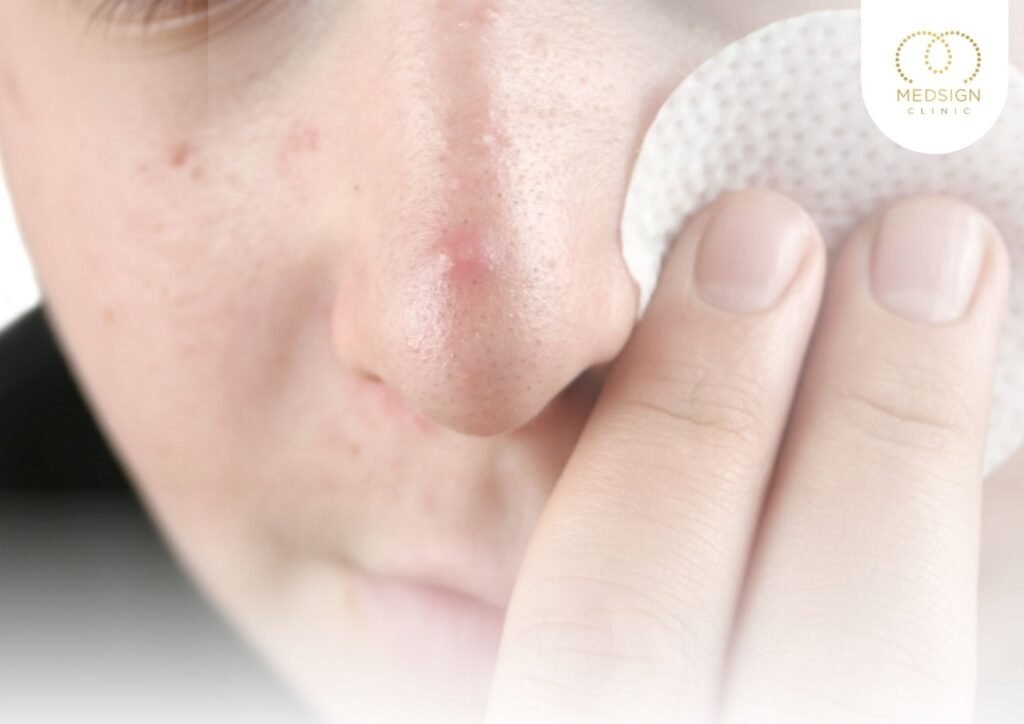 คลินิกกดสิวเชียงใหม่ ควรเลือกอย่างไรให้ปลอดภัยและเห็นผล