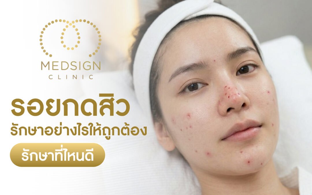 รอยกดสิว รักษาอย่างไรให้ถูกต้อง รักษาที่ไหนดี