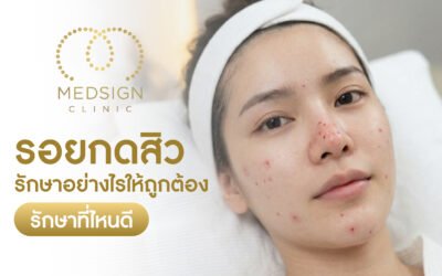 รอยกดสิว รักษาอย่างไรให้ถูกต้อง รักษาที่ไหนดี