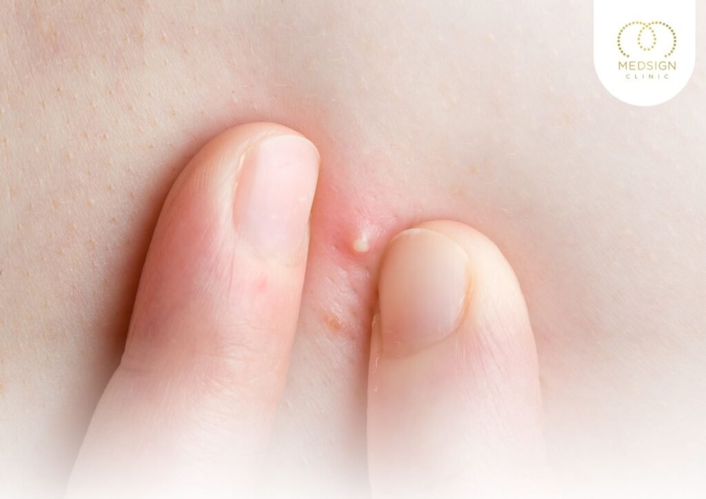 วิธีรักษาสิวอักเสบที่ถูกต้อง