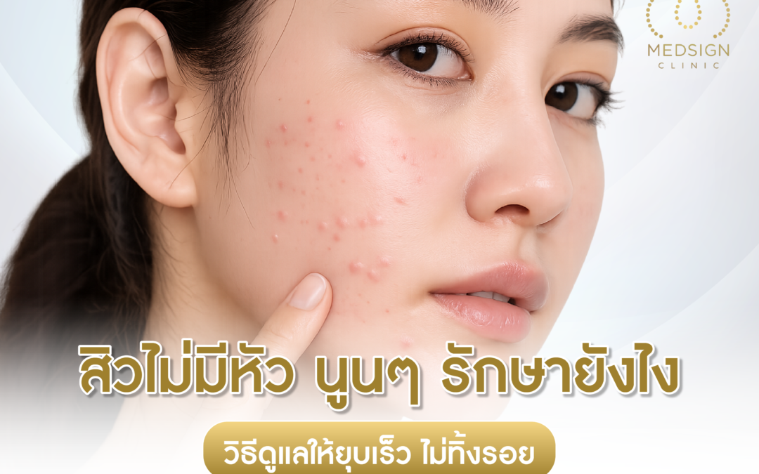 สิวไม่มีหัว นูนๆ รักษายังไง วิธีดูแลให้ยุบเร็ว ไม่ทิ้งรอย