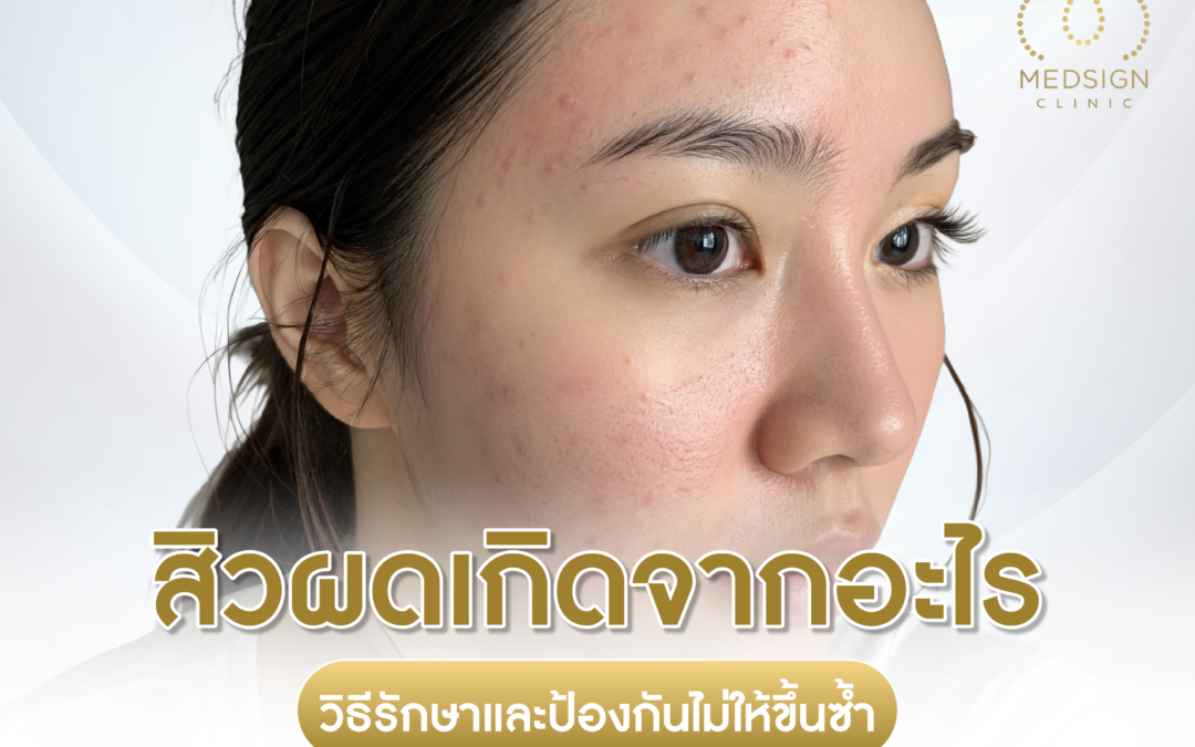 สิวผดเกิดจากอะไร วิธีรักษาและป้องกันไม่ให้ขึ้นซ้ำ