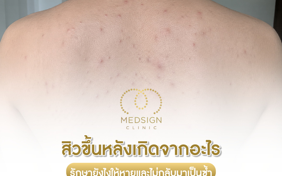 สิวขึ้นหลังเกิดจากอะไร รักษายังไงให้หายและไม่กลับมาเป็นซ้ำ