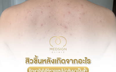 สิวขึ้นหลังเกิดจากอะไร รักษายังไงให้หายและไม่กลับมาเป็นซ้ำ